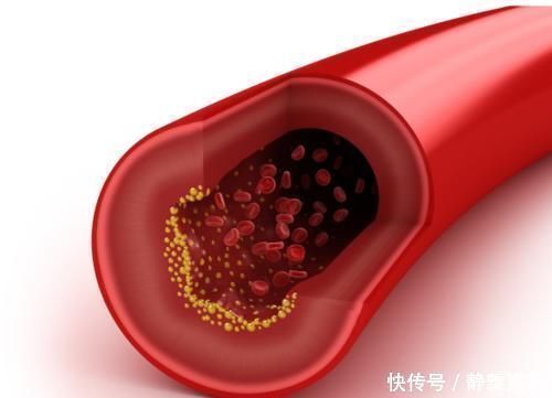 用药|心血管患者吃他汀,血脂已经正常,可以减半服用吗?辟谣来了