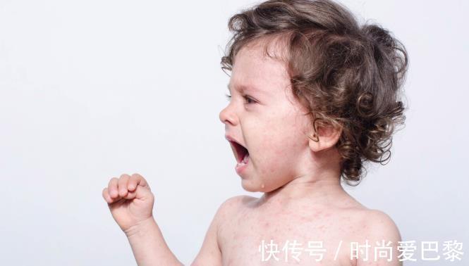 痱子粉|宝宝身上起了痱子,不可以用痱子粉怎么办?试试这几个方法
