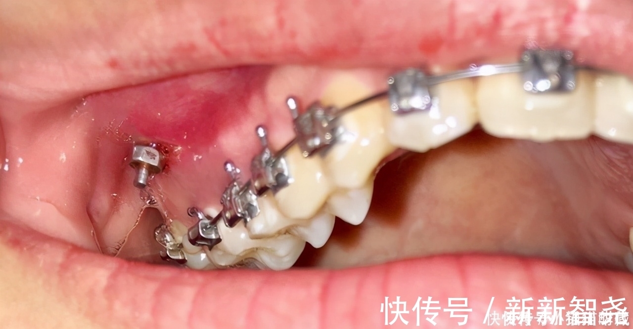 牙槽骨|牙齿矫正一般是什么时候打骨钉?矫正是不是必须打骨钉?