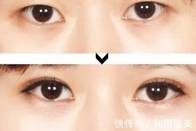 手术 想割双眼皮手术前,先看一下你的双眼合适割双眼皮手术吗?