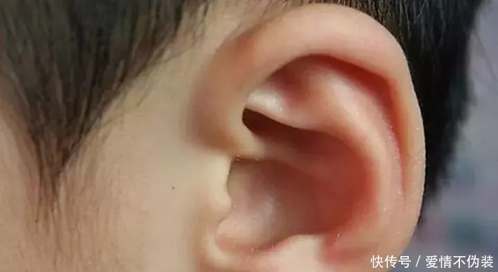 积食引发的中耳炎,如何调理