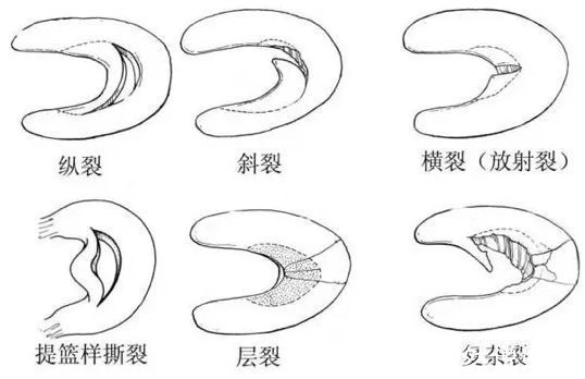 事儿|运动后，你的半月板还好么关于半月板的这点儿事儿！