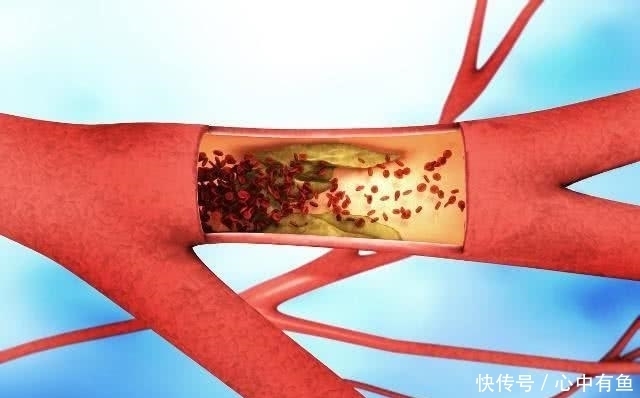 血压稳定后,可以停用“降压药”吗?这对高血