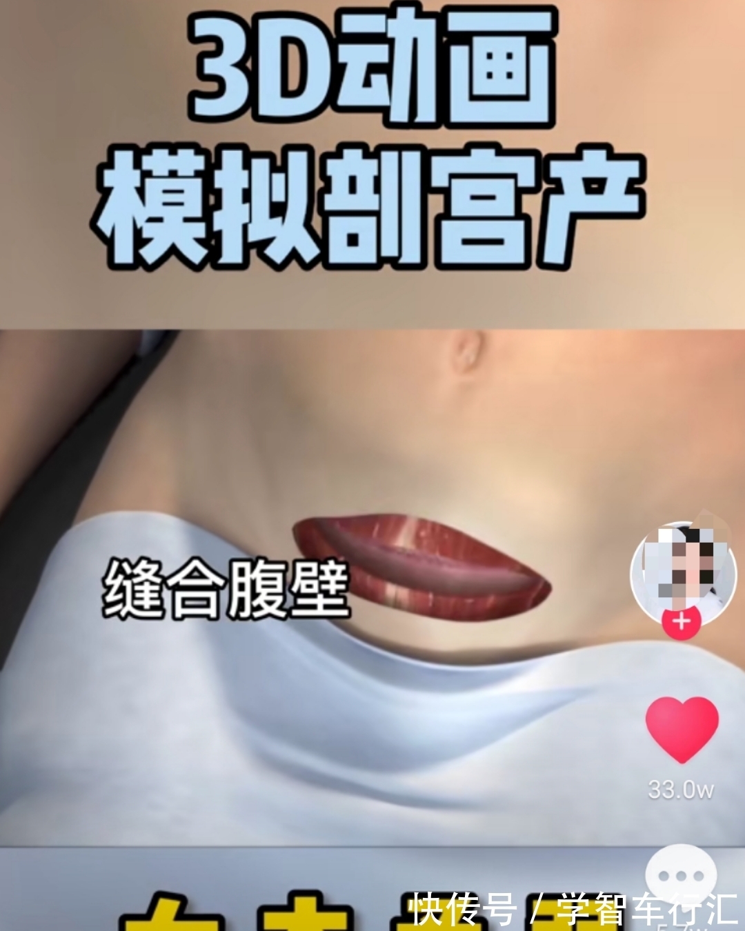 谢楠|剖宫产有多“伤”妈妈,几张3D过程图带你了解,感恩老婆和妈妈