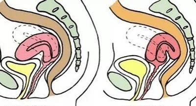 子宫前倾|这四种特征的女性很容易怀孕，你属于哪种