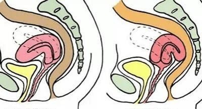 子宫前倾|这四种特征的女性很容易怀孕,你属于哪种