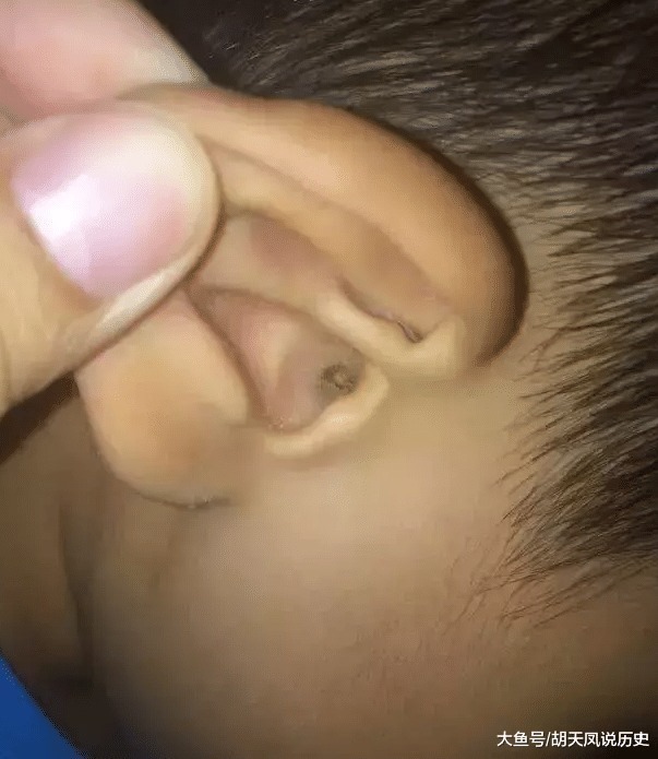 大夫|花了700块给娃掏了次耳屎, 才知道耳屎不是想掏就掏