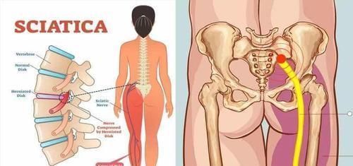 五个动作坚持练,帮你赶走坐骨神经痛,还你