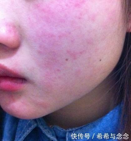 敏感肌|别买这“三类成分”的护肤品,孕期上脸就过敏,第一个大家都用过