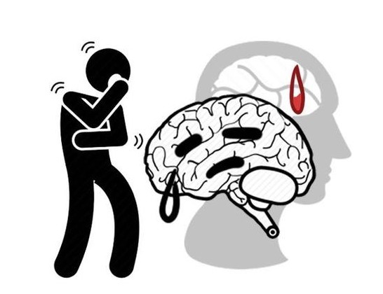 尼古丁|什么人更受脑梗“偏爱”？这4个“过人”之处，希望你一个也不占