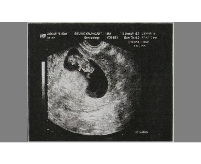 b超|怀孕后孕囊发育很重要，多久才能看见孕囊？为什么说孕囊很重要？