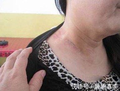 肉疙瘩|身上为什么会长出小肉疙瘩身体在向你表达什么呢