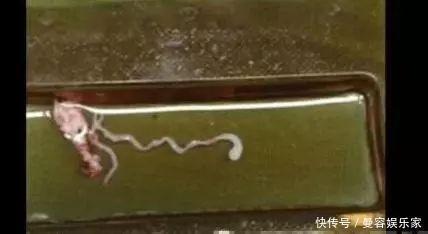 小男孩|7岁小男孩,脑中发现8厘米长虫,医生孩子妈太无知,害了孩子