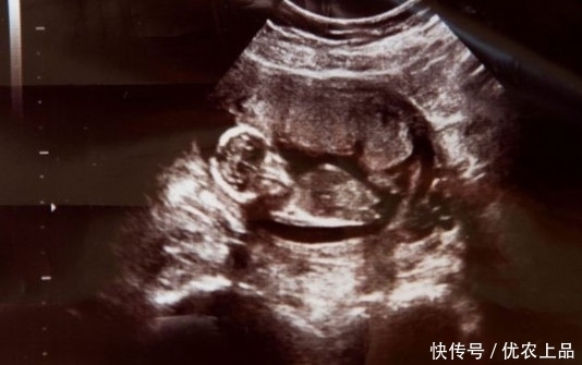 胞胎姐妹被妈妈用药物流掉,她却在母亲腹中安稳存活