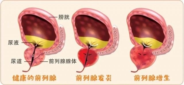 肝癌|癌症也有“小性格”！摸透它的脾气识别早期征兆