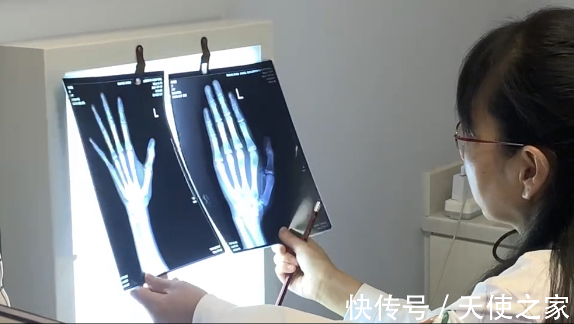 天使讲堂|天使讲堂:关于孩子骨龄,您了解多少!