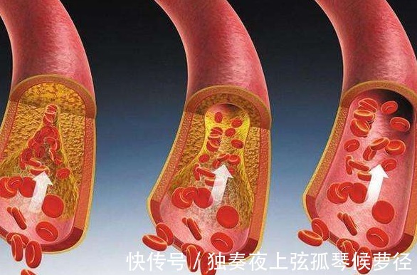 血脂升高|89岁朱院士提醒甘油三酯偏高,牢记3句话,或有利于稳定血脂