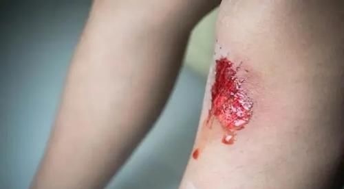 血脂升高|血脂高不高,看脚就知道,若没有这4种症状,恭喜,血管还算通畅