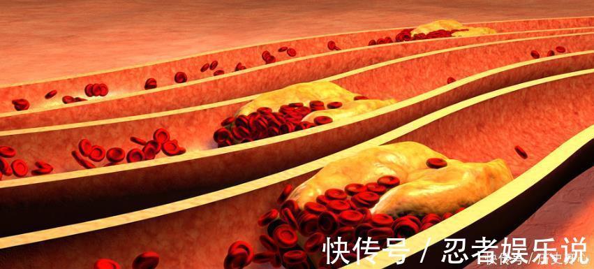 血液循环|腿部有5症状,可能血脂高了,做好1件事,不出1个月,血脂降了