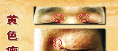 高血脂|天然“他汀”放1勺，连喝15天，专攻高血脂、疏通血管、血栓不来