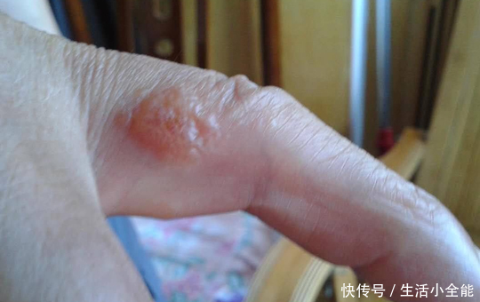 小痘痘|小孩手上起小米粒疙瘩很痒!一定要注意!