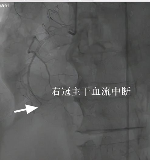 心肌|7旬大伯急性心梗并发室间隔穿孔，心肌烂成“豆腐渣”，浙大二院医生上演心尖上的艺术