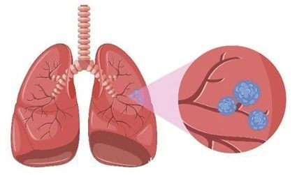 专利|成都中医肿瘤研究院万年路2号：怎样消除肺结节？中医专利组方辨证论治