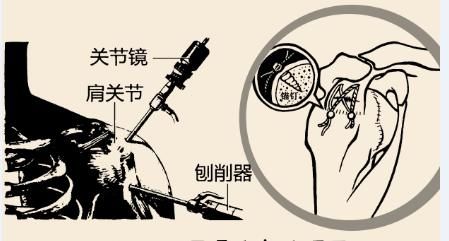 肩峰|“肩痛治疗走了弯路”，医学博士告诉你这种既省钱又实用的方法