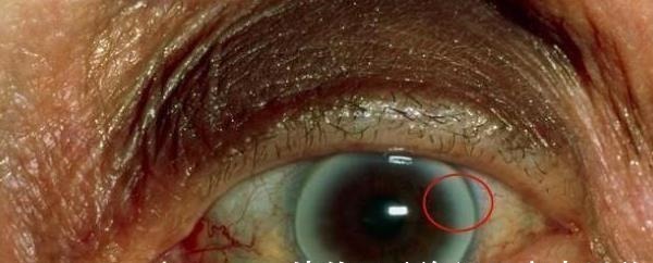 眼角膜|血脂高不高,看脸便知晓?脸上出现4大表现,要注意降低血脂了