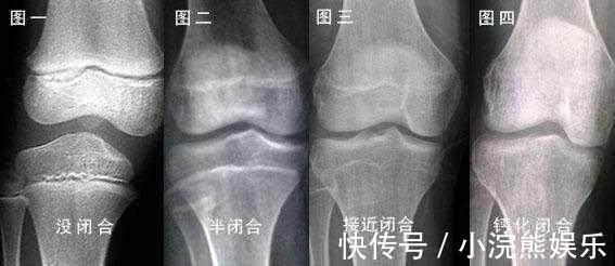 遗传因素|孩子是天生矮还是发育晚答案已经透露给了父母,第一个很明显