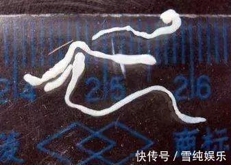 豪豪|7岁小男孩,脑中发现8厘米长虫,医生孩子妈太无知,害了孩子