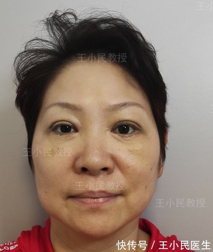 软组织 王小民教授:面部线条不流畅,松弛下垂的“赘肉”才是罪魁祸首!