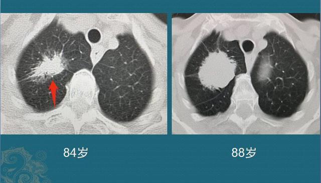 黄勇|肺腺癌是怎么长出来的医生介绍3类肺结节，像种子发芽