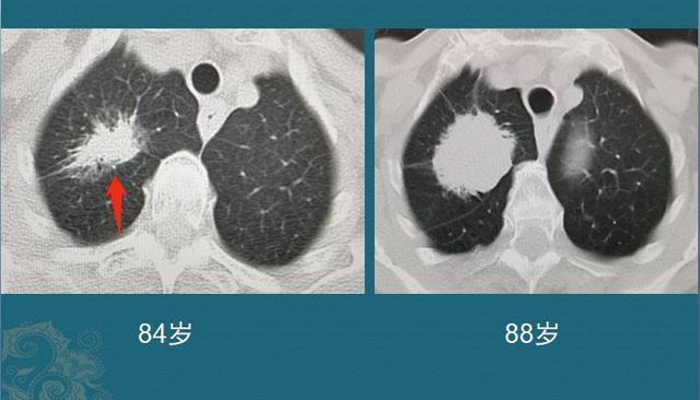 黄勇|肺腺癌是怎么长出来的医生介绍3类肺结节,像种子发芽