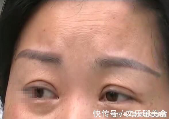 双眼皮 女子花5800做双眼皮手术“变”单眼皮,欲退款遭拒,店家收据呢