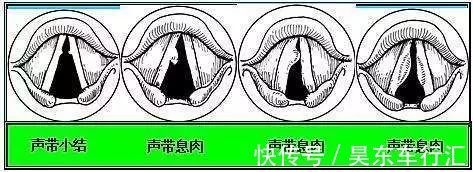 胃镜|长大后，它就成了癌！到底要多久？看完这篇，了解息肉的全部