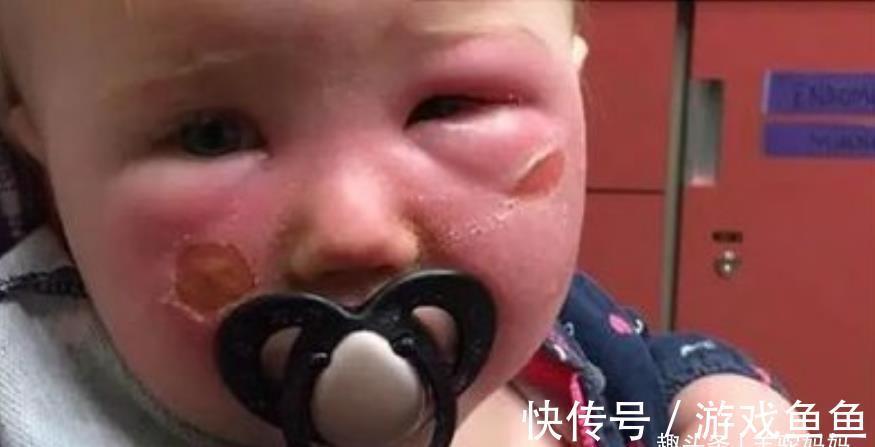 晒伤|夏天给孩子用错“防晒”伤害有多大?用我亲身经历告诫,父母注意