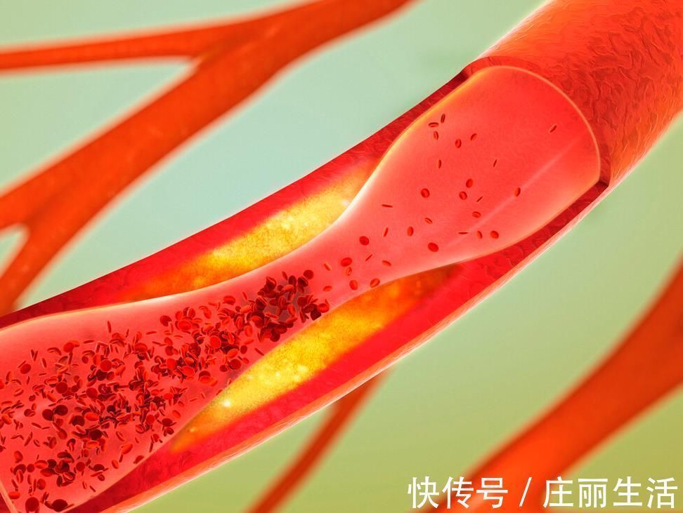 血脂异常|高血脂的祸根被发现,吃肥肉仅排第三,排首位的很多人都喜欢吃