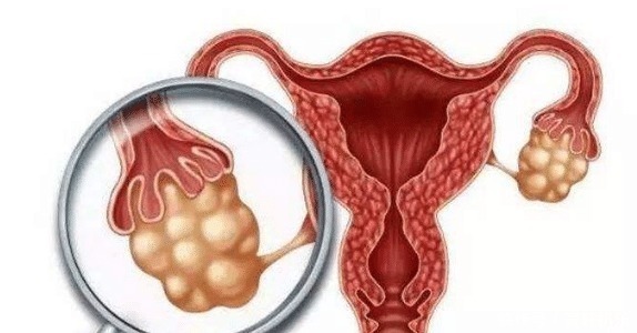 炎症|出现以下3种典型病症,大概是患上宫颈癌了,你有可能还不知道