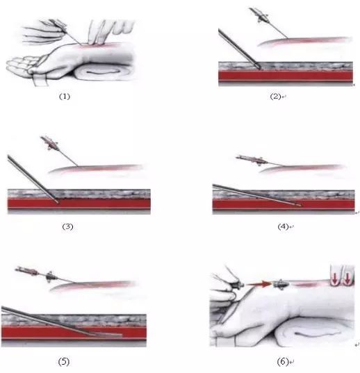 套管|聚焦临床丨盲法桡动脉穿刺，深度解析！