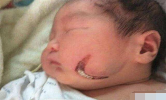 消退|孩子脸部“产钳印”没消退,婆婆怨儿媳没本事顺,网友好心凉