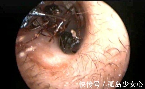 女孩|女孩耳朵疼,医生往女孩耳朵边放糖,结果出来了让人害怕的东西