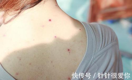 皂基型|背部毛孔粗、爱长痘?原来是沐浴露的问题!