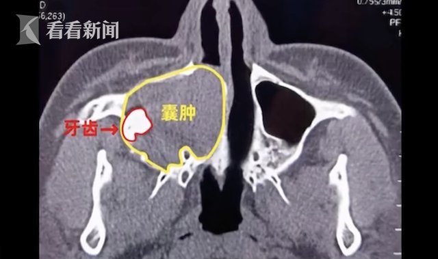 上颌窦|惊呆！男子鼻腔长了牙 医生：40年没见过这情况