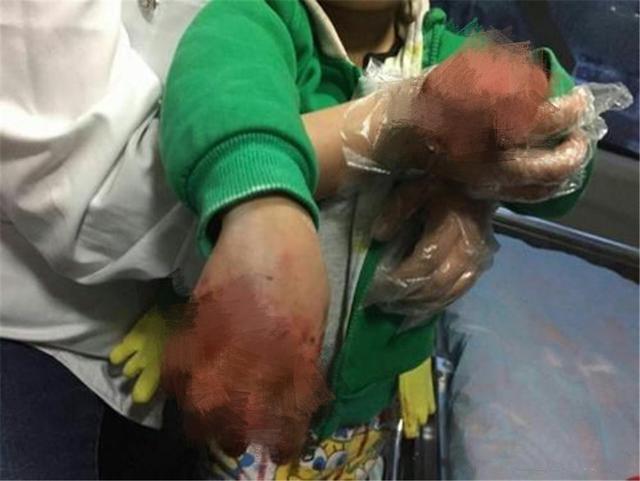 小丽|小女孩双手伸进油锅,奶奶教科书式处理保住孩子双手,医生都称赞