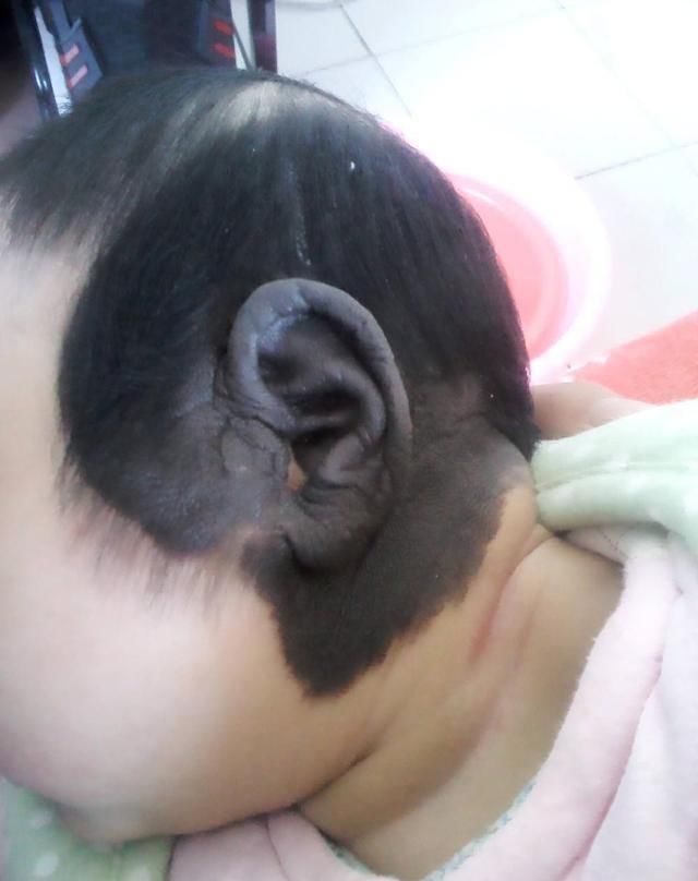 孕期|胎记到底是怎么来的医生孕期避开这3种行为,可减少胎记产生