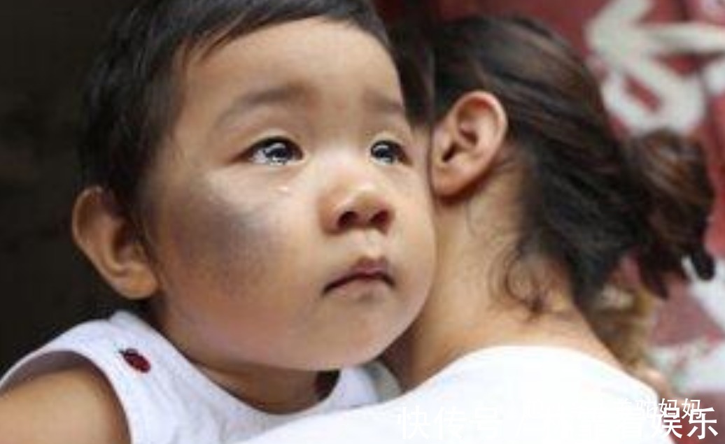 化学物质|越来越多胎儿被“胎记”缠身,若不想孩子自卑,孕妈要管住自己