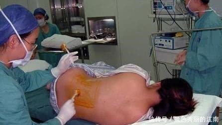 剖腹产|剖腹产麻醉后,产妇有啥感觉,看经历过的妈妈们怎么说