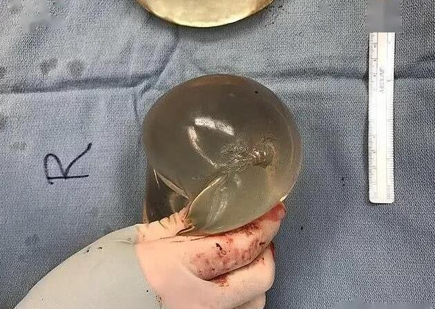 隆胸硅胶假体还能防弹一女子枪口下幸存,医生看完一脸懵