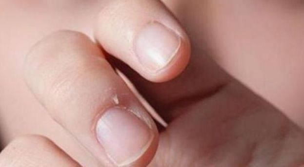 家长|孩子手上经常出现“倒刺”,家长着急,可能是3个原因引起的